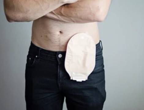 Ostomía