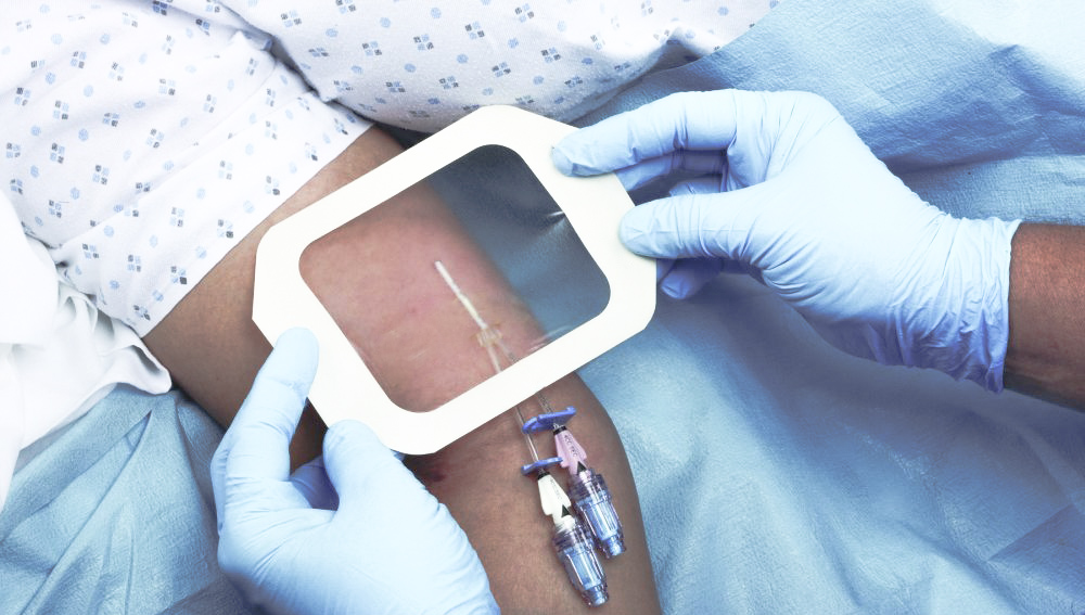 <ul><li>Acrylic frame dressing - polyurethane film for catheter support </li></ul>